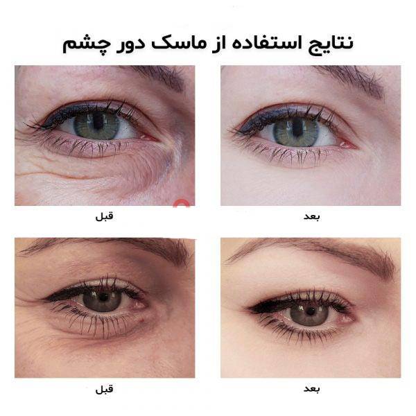 پچ زیر چشم ورقه ای