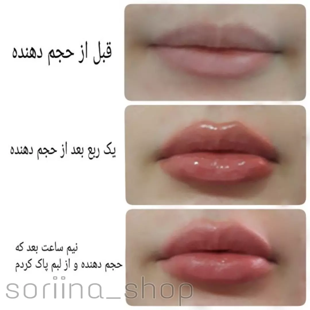 حجم دهنده فوری لب